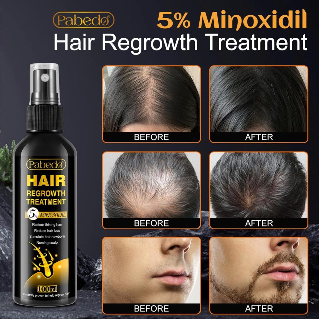 5% Minoxidil for Men and Women Hair Growth Serum - Castor Oil  Biotin Hair Growth Spray Hair Regrowth Treatment for Scalp Hair Loss Hair Thinning For Thicker Longer Fuller Healthier Hair 100Ml
